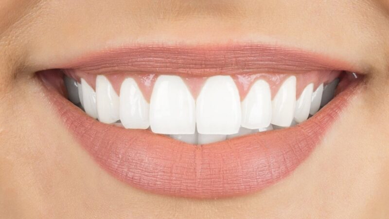 Teeth Whitening: Know More About Hydrogen Peroxide